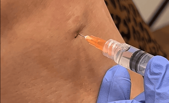 A gloved hand is injecting a syringe with an orange needle cap into the skin near a persons navel.